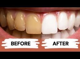 An image of teeths before and after